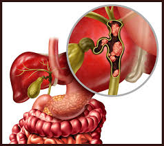 bile duct cancer